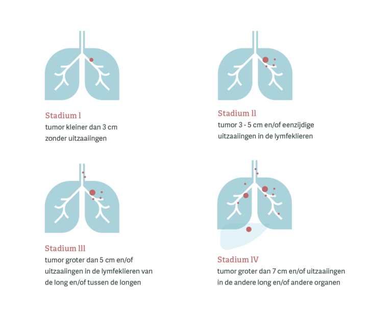 Opsporing longkanker | AVL Centrum voor Vroegdiagnostiek